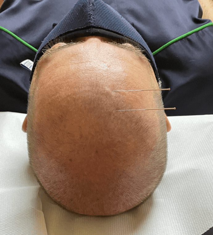 cs-acupunctura-facial